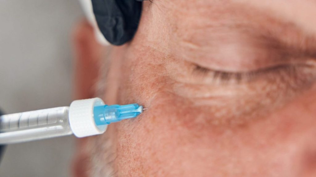 ácido hialurónico homem bioestimuladores